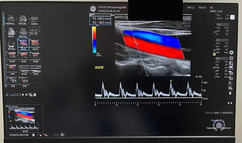 Doppler colorido de carótida: fluxo em vermelho e azul com espectro de velocidades