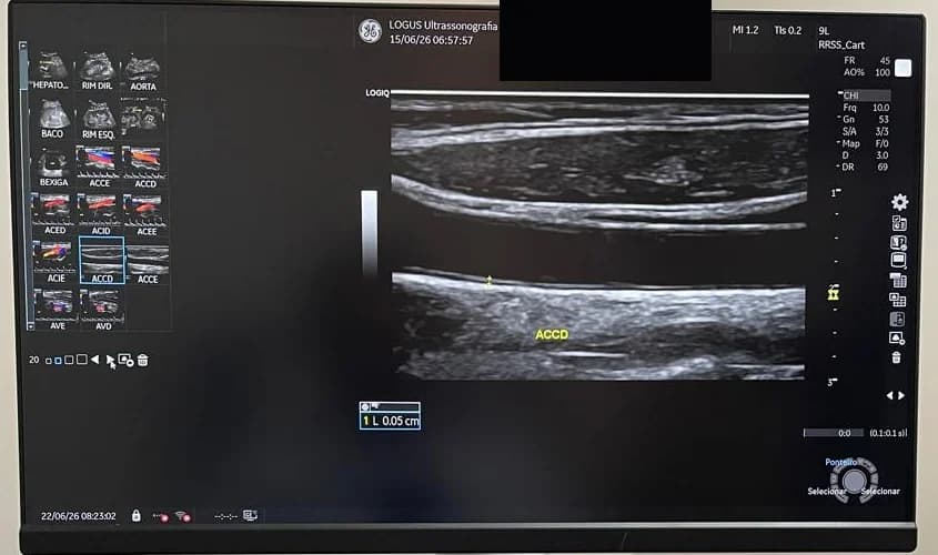 Ultrassom em modo B da parede da carótida com medida milimétrica