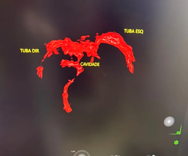 Reconstrução 3D HDLive de um HyCoSy mostrando a cavidade uterina e as trompas direita e esquerda pérvias