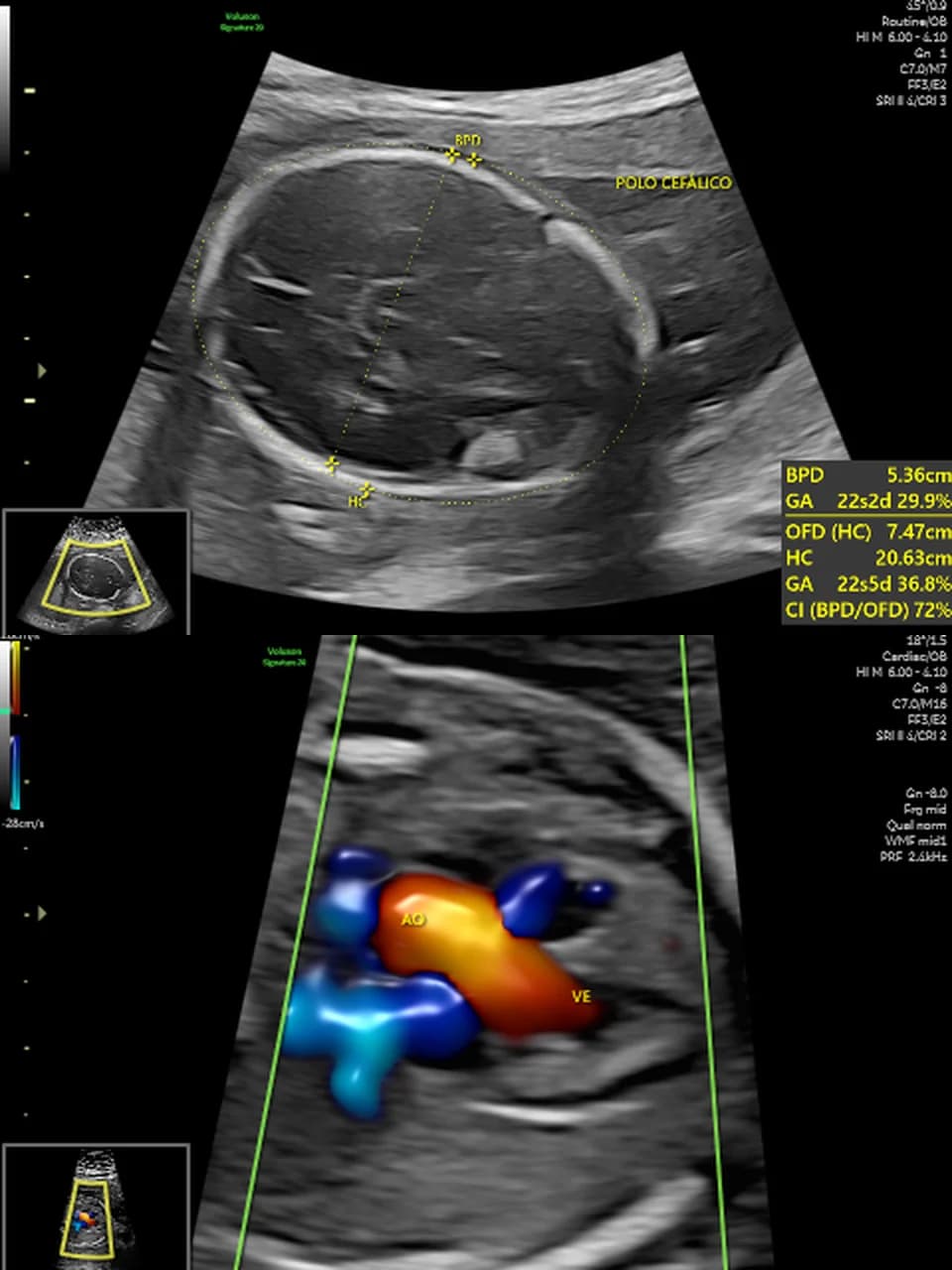 Ultrassom morfológico na LOGUS: biometria do polo cefálico e Doppler colorido do coração fetal